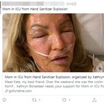 손 소독제 바르고 촛불켜다 '펑'···전신 3도 화상 입은 美여성