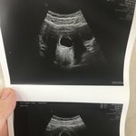 임신<b>낭</b>은 보이는데 태아가~