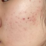 내 피부 구원해주라 어캄 (혐주의)