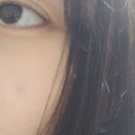 나 볼에 멍들었음