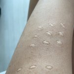 <b>불주사</b> 자국 나보다 심한 사람있냐