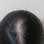 나 <b>탈모</b> 초기인가...?