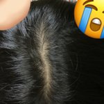 [이것좀봐줘] 나 <b>탈모</b>야..????!!!!!!!!???!??!?...