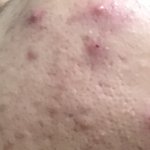 [댓글부탁해] 피부 관리 방법 좀 알려줘 제발...ㅠㅠ