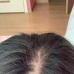 나 <b>탈모</b>같음??