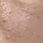 [드루와] 여드름 피부 탈출 후기 알려줌!!들어와 +추가)