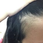 나 탈모 개오짐 아니 그냥 <b>선천</b>적으로 머리가없음