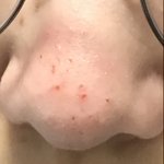 나 코 피지 <b>충동</b>적으로 손톱으로 다 긁음 어캄 ㅆㅂ