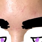 [댓글부탁해] 피부 변화..ㅃㄹ다시 피부과 약 먹어야??