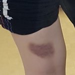 [드루와] <b>유연</b>성테스트하다 다리 ㅈㄴ멍듬