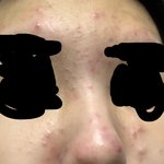 [댓글부탁해] 피부과 <b>가야</b>될지 추반좀