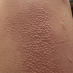 [이것좀봐줘] <b>혐오</b>주의⚠️나보다 두드러기심한사람 이세상에 없음