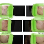 [댓글부탁해] 화농성+<b>좁쌀</b>여드름 엄청 심했는데..싹고침. 뭐든물어봐