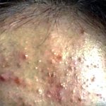 [이것좀봐줘] <b>좁쌀</b>엔 클리어틴이야ㅈㅂ 전후비교사진