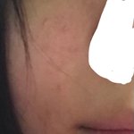 [ㅈㄱㄴ] ㅆ1발 내얼굴에서 여드름파티한 다샛<b>개들</b>