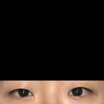 [댓글부탁해] 꼬막눈 쌍수 2년 차 후기