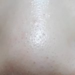 [드루와] 와 블랙헤드ㅈㄴ심해
