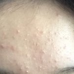 [드루와] <b>클리어틴</b>바르고 좁쌀 들어감