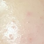 [이것좀봐줘] 피부 <b>좁쌀</b>..? 도와줘(사진 약혐짤