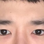 사진)눈 성형6개월찬데..