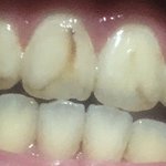 치아 갈색 <b>변색</b>