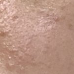 [댓글부탁해] 여드름 있는 애들 <b>백퍼</b> 효과 있는 템 추천 해줌