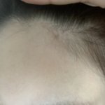 [댓글부탁해] 헤어라인에 여드름 첨 나보는데