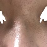 [이것좀봐줘] <b>좁쌀</b> 없애는 법좀