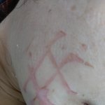 [댓글부탁해] 부산 피부과에서 <b>토닝</b>하다 2도 화상을 당했습니다....