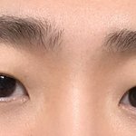 <b>눈성형</b> 고민중인 남자인데요 (앞트임)