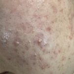 (사진ㅇ)나 <b>여드름약</b> 먹고 인생이 바꼈어