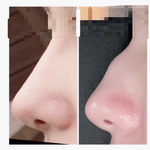 메<b>부리</b>코 컴플렉스 고쳤는데 봐죵