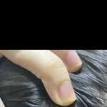<b>두피</b> 뾰루지나 봐라