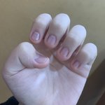[알려줘] 8년 동안 물어뜯은 <b>손톱</b> 어떡해야할까요