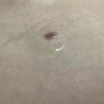[댓글부탁해] 피부과에서 점 뺐는데 흉터가 남았어요.. 한번만 봐주세요ㅠㅠ