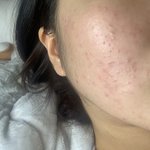 [댓글부탁해] 나 피부가 이상해ㅠㅠ