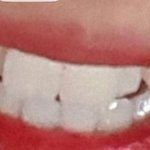 [댓글부탁해] <b>덧니</b> 어때