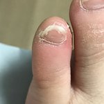 야 제발 씹극혐주의) 나 이거 <b>무좀</b>이냐 발톱<b>무좀</b>