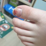 <b>발톱</b> 부러졌는데 우째해야함?