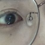 [쌍수후기] 쌍수<b>매몰</b>후기