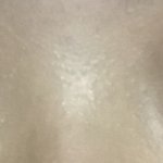 내 <b>쌍수</b> <b>전</b> 후 어떰...?