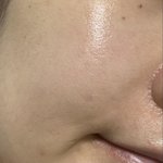 [의료상담] 2주만에 턱드름 <b>박멸</b>한 후기!!!