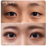 [ㅈㄱㄴ] 와 쌍수<b>전후</b> 개쩐다