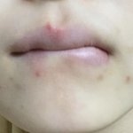 마스크때문에 턱쪽에 <b>난리</b>났어ㅠㅠㅠㅠㅠㅅ부ㅠㅠㅠㅠㅠㅠㅠㅠㅠㅠㅠㅠㅠㅠㅠ