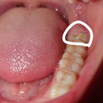 [댓글부탁해] 사랑니 <b>발치</b> 후기(아픈거 말고 딴거 뽑음)