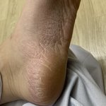 [실화] 나보다 발 갈라짐 <b>각질</b> 심한사람있냐