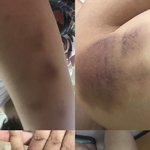 광주 남구 ㅇㅇ병원 장애인 폭행사건 널리퍼뜨려주세요