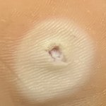 [혐주의] 티눈 이거 뽑으면 되는<b>구야</b>ㅠㅠ??