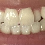 [댓글부탁해] <b>덧니</b> ㅇㄸ