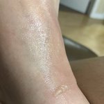 얘들아 나 이거 화상 <b>물집</b> 어떡해?